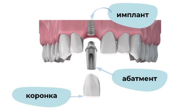 Этап 8 имплантации