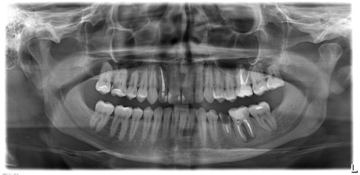 Лечение зуба под микроскопом цена спб thumbnail