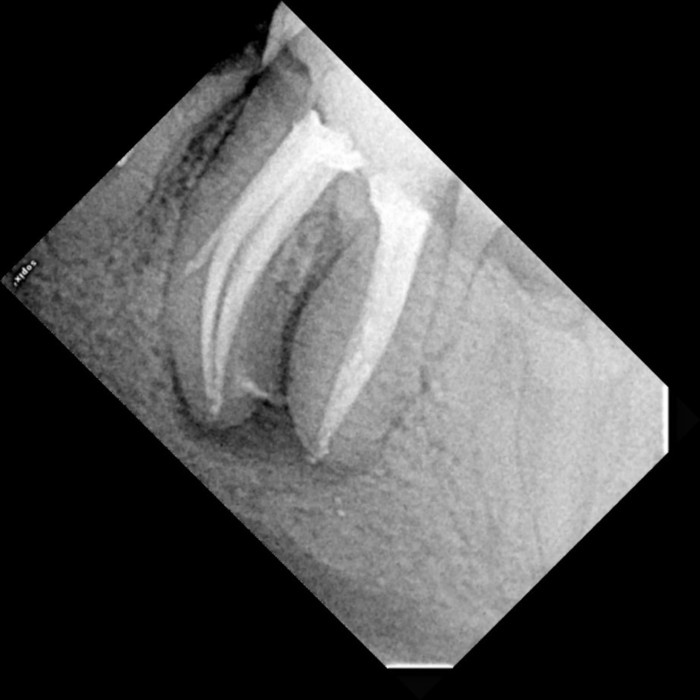 Лечение зуба под микроскопом цена спб