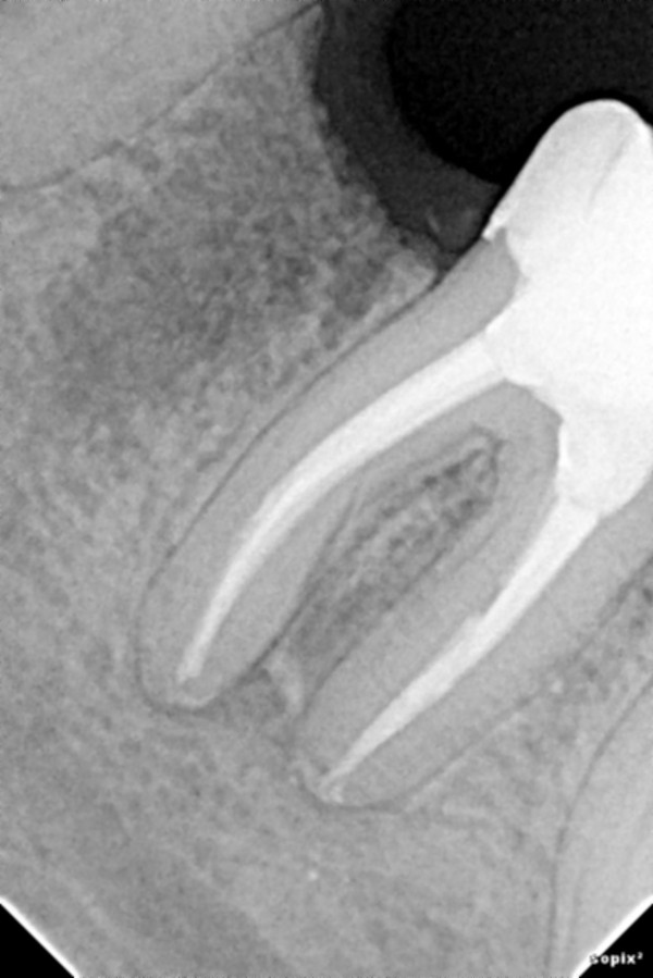 Лечение зубов с микроскопом спб thumbnail