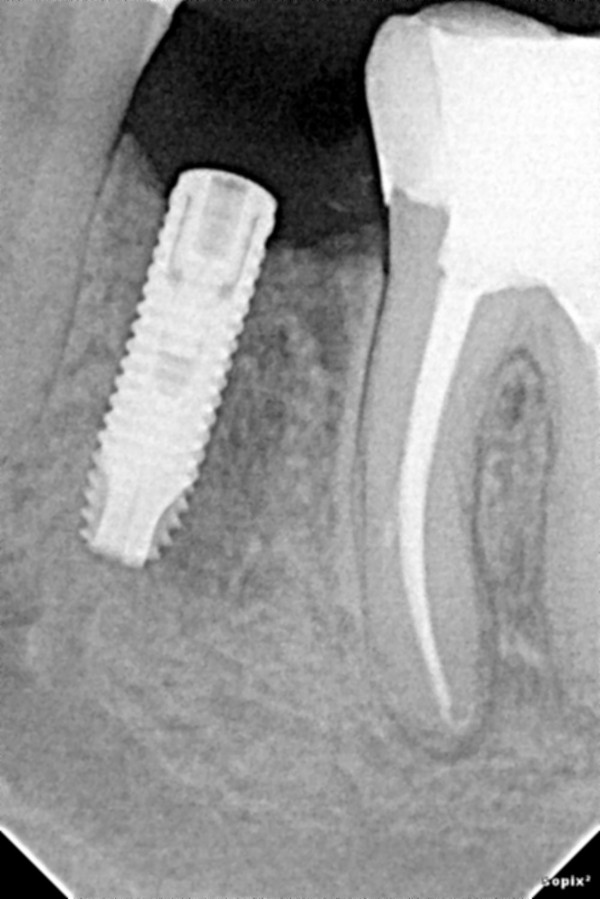 Лечение зуба под микроскопом спб