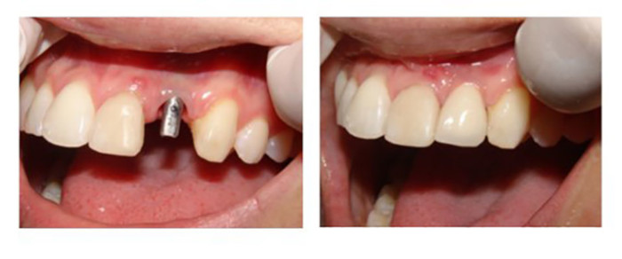 Пример имплантации передних зубов в клинике «МедГарант»