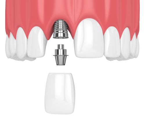 Коронка на имплантате переднего зуба