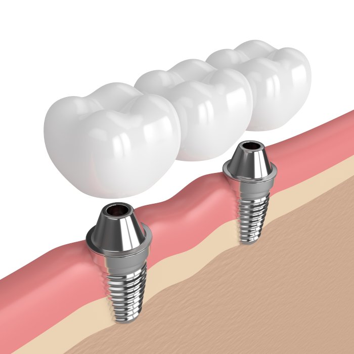 Импланты Nobel Biocare при потере нескольких зубов