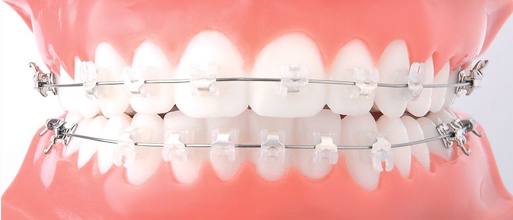 Ортодонтия по доступной цене в клиниках «МедГарант»